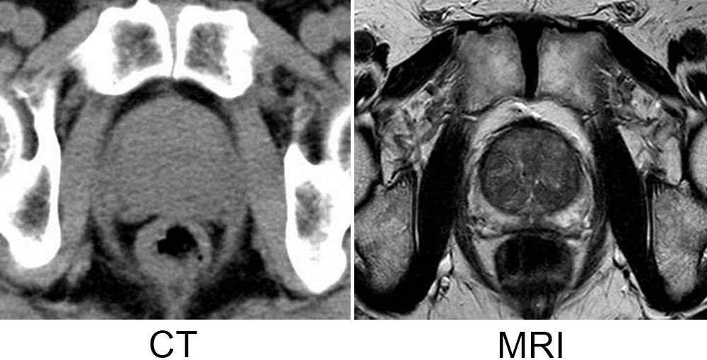 写真:前立腺の画像をCTとMRIで比較