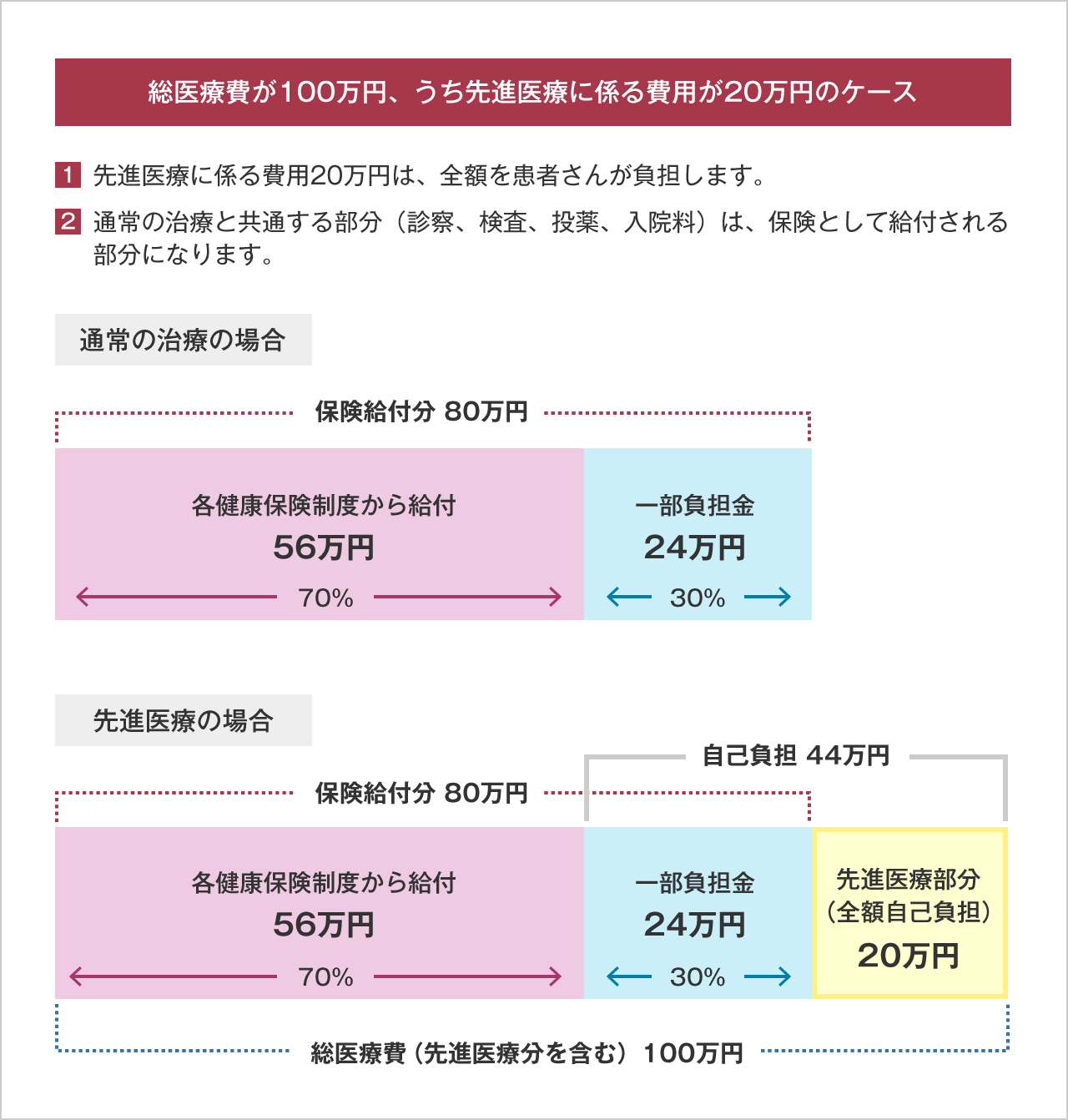 図：総医療費が100万円、うち先進医療費用が20万円の例。先進医療費用は全額自己負担、通常の治療と共通する80万円が保険診療になる。